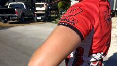 Major sunburn on the triceps